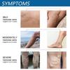 Yousheng 30ML Varicose Vein Massage Spray Relieve Leg Discomfort Improve Circulation Gentle Effective Varicose Spray