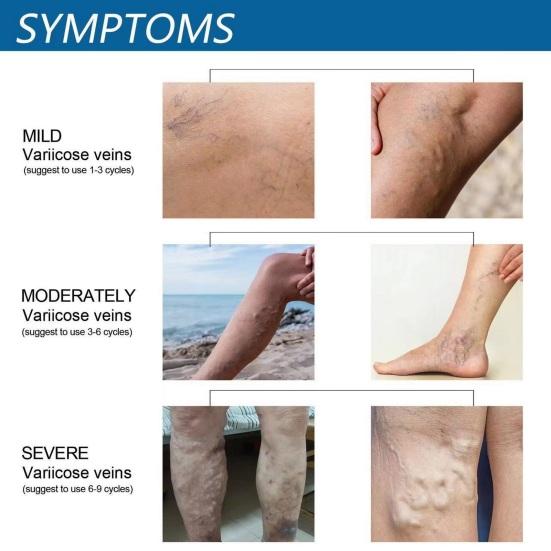 Yousheng 30ML Varicose Vein Massage Spray Relieve Leg Discomfort Improve Circulation Gentle Effective Varicose Spray