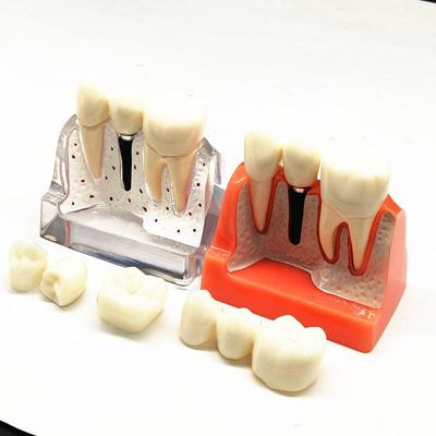 1 Piece 4 Times Dental Teeth Teaching Study Model Dental Implant Disease Analysis with Restoration Crown Bridge Demonstration