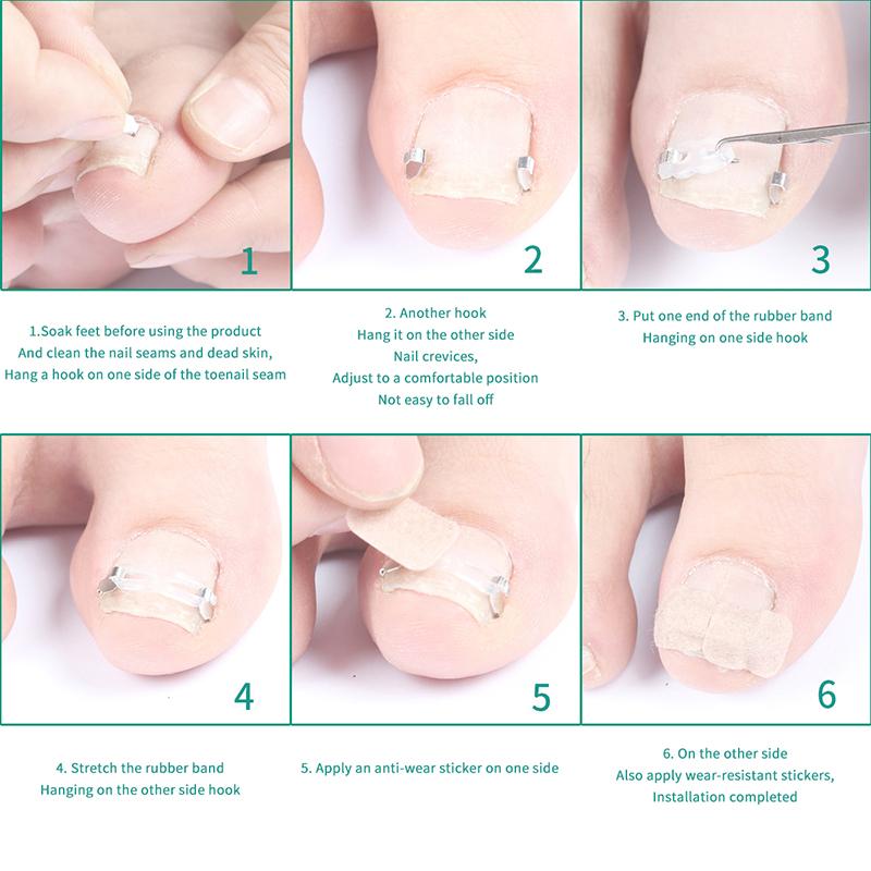 1/2 Set Ingrown Toenail Corrector Tools Pedicure Recover Embed Toenail Treatment Professional Foot Care Correction Tool