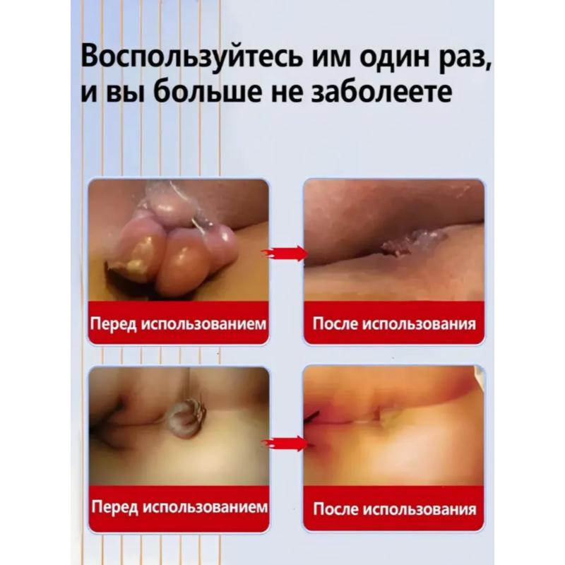 Chinese Hemorrhoid Ointment for Piles and Fissures, 20 Ml