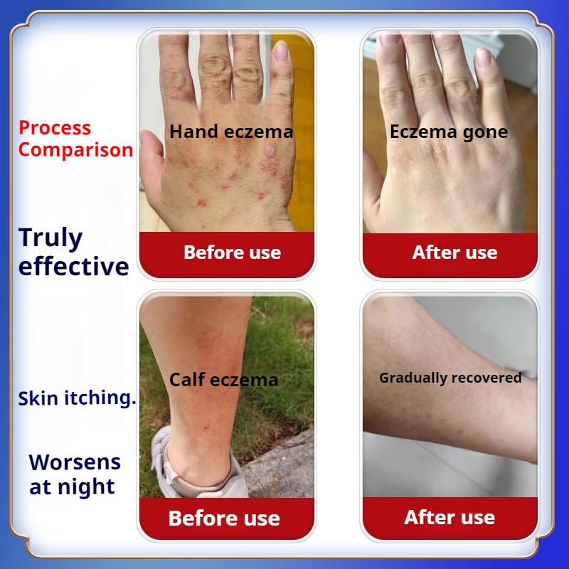 Schnelle Rötungslinderung & Juckreizpflege Hautausschlagcreme