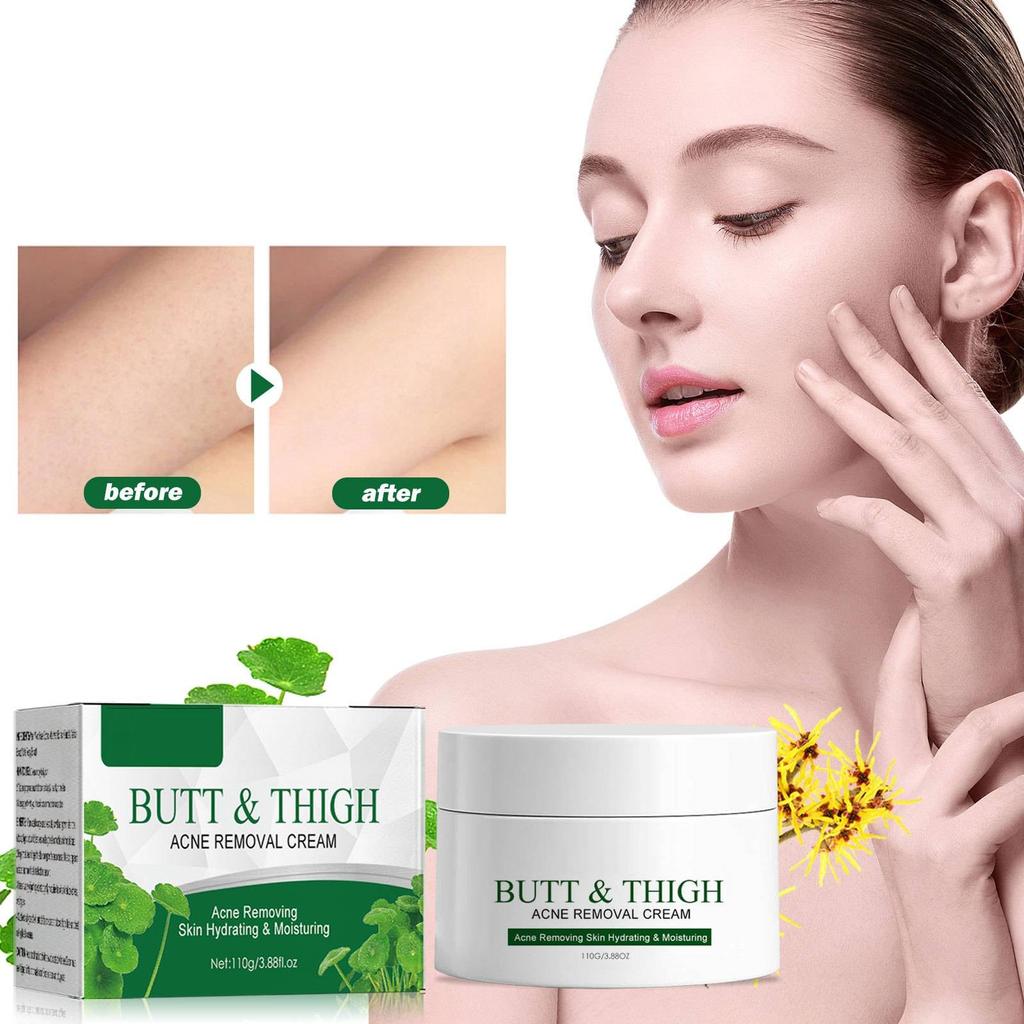 Body Acne, Skin Acne Plant Extracts Are Gentle Acne And Acne-free, Skin Smoothing Care, Gentle And Non-irritating,3.99fl.oz/110g