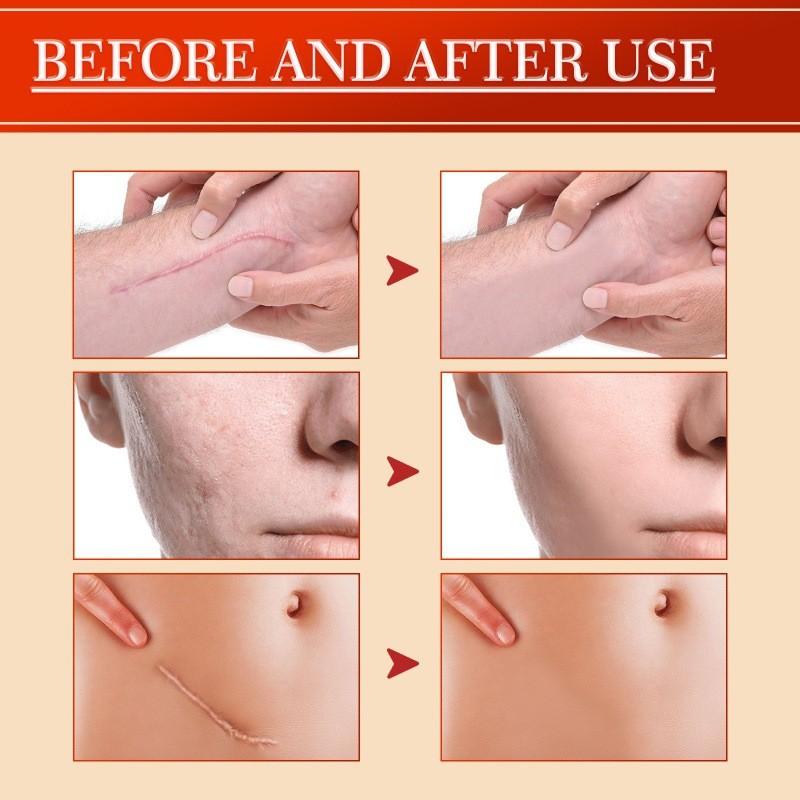 South Moon Centella Scar Repair Cream Moisturizing Skin Tightening And Smoothing Formula For Scars And Blemishes