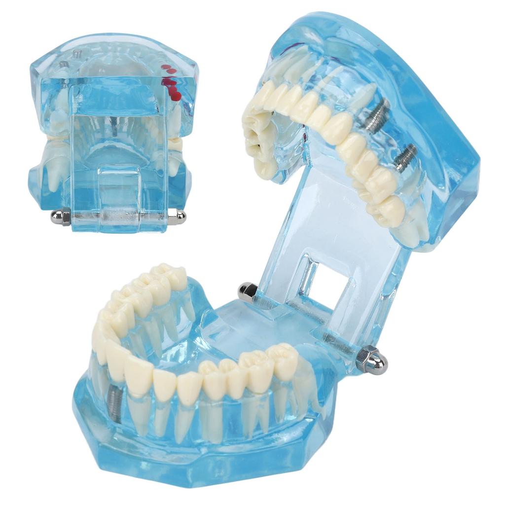 Dental Pathological Model Clear Teaching Detachable Dental Teeth Display Model Blue Transparent