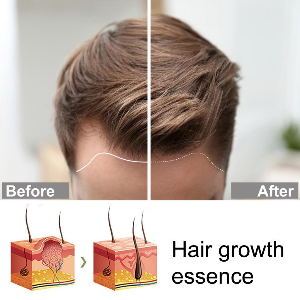 OUHOE Ginger Hair Essence 30ml promotes hair growth, prevents dry, damaged, and thinning hair, and acts as an anti-hair loss and hair growth spray