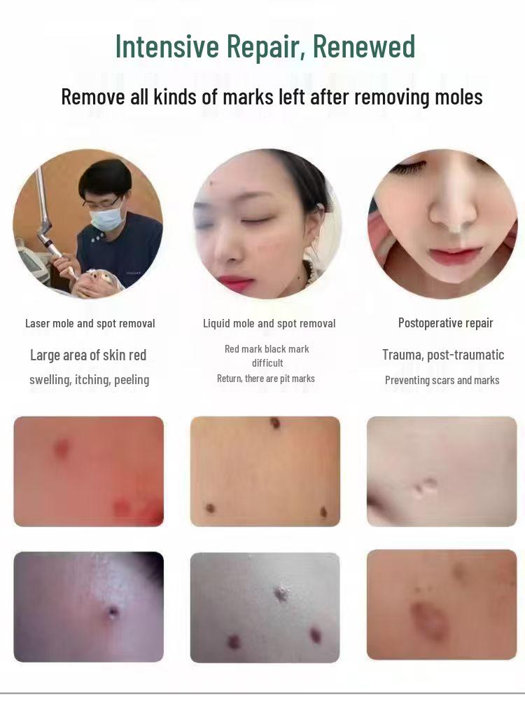 Repair Cream for Sunburns, Freckles, and Moles - Nourishes, Reduces Redness & Swelling, and Soothes Skin - Salon Exclusive