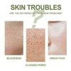 Ouhoe Blackhead Removal Essence Set - Cleanses Pores, Refines Skin, Controls Oil, Repairs Acne, Blackheads, And Nose Strips