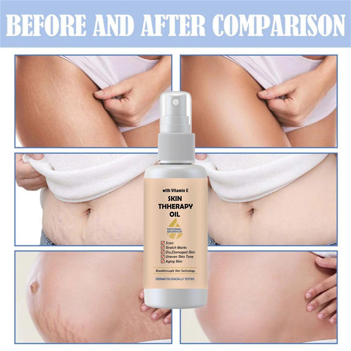 

Крем для восстановления при беременности, удаление растяжек, удаление шрамов от прыщей, крем от растяжек, лечение жировых стрий беременных, кремы для тела