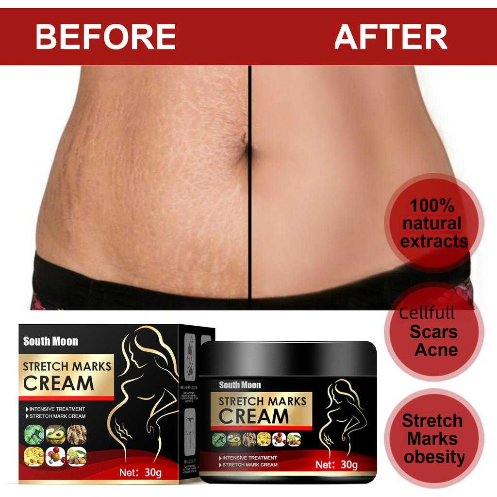 South Moon Scar Repair Cream Tightens Skin And Reduces Postpartum Scars