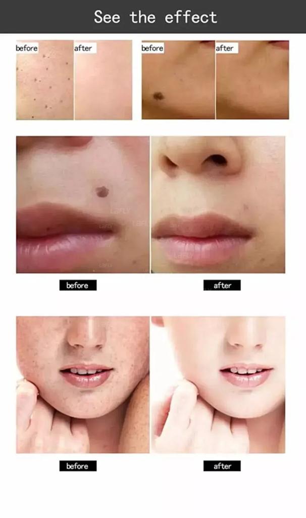 SPA Use Cold Plasma Pen Ozone Acne Remover Wrinkle Removal Skin Rejuvenation Sterilization Anti-inflammation Beauty Instrument