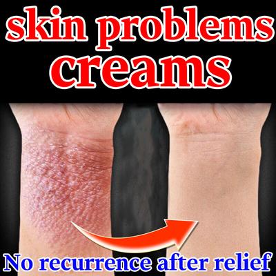Natürliche pflanzliche Ekzemcreme - Beruhigt juckende Haut Sanft für empfindliche Typen Lindert Dermatitis