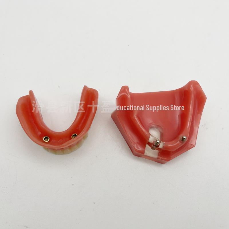 Modello Didattico Dentale: Arcata edentula con protesi rimovibile e 2 impianti
