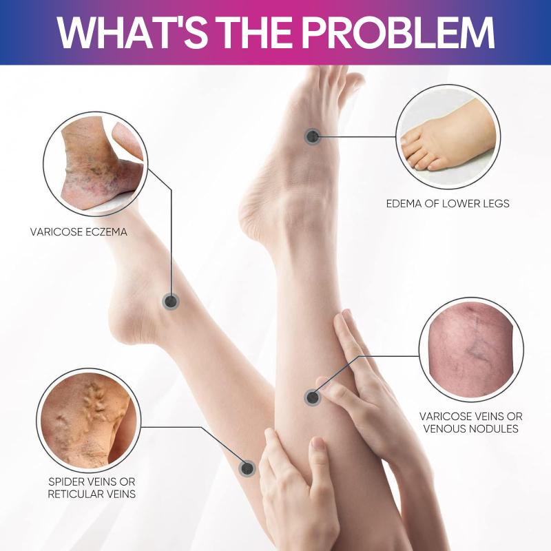 Cream Leg Swelling Relief Eliminate Vasculitis Phlebitis Improve Spider Veins Soothing Cream