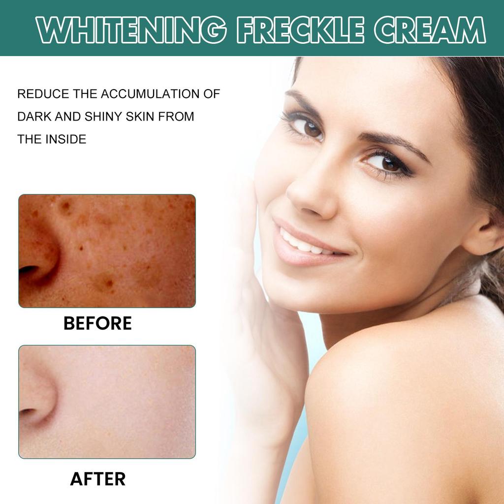 EELHOE Nicotinamid-Sommersprossencreme, feuchtigkeitsspendende Gesichtsaufhellungsreparatur, Hautpflege, Melasma-Entferner, Pigmententfernungscreme, 30 g