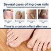 50 Pcs Ingrown Toenails Patch Sticker Toenail Patch Corrector Pedicure Tools Ingrown Toenail