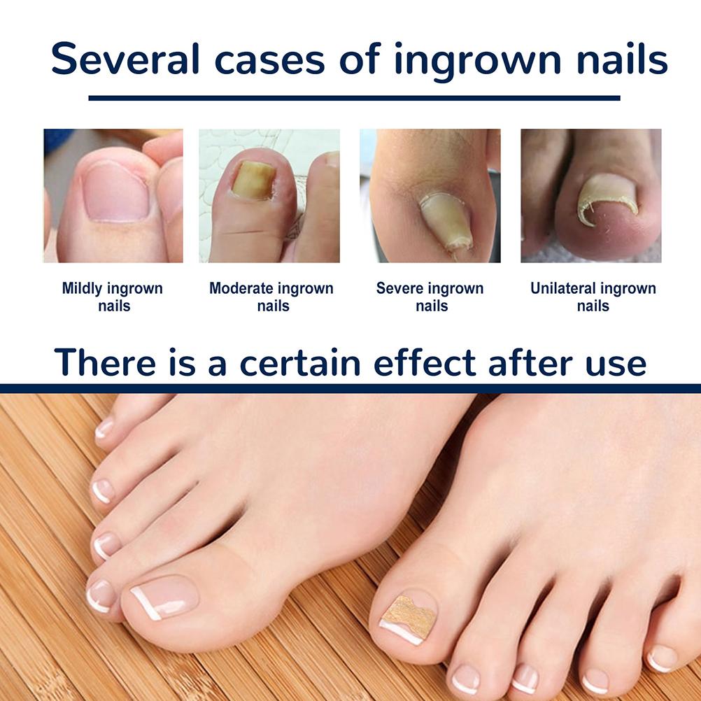 50 Pcs Ingrown Toenails Patch Sticker Toenail Patch Corrector Pedicure Tools Ingrown Toenail