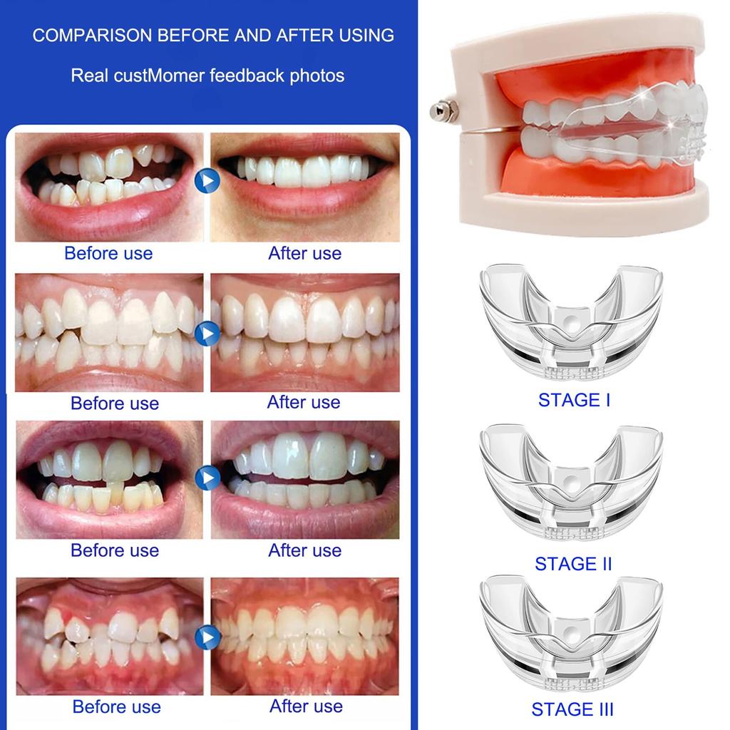 Bretele ortodontice Transparent Smile Teeth Alignment Trainer Dispozitiv de reținere a dinților din silicon instantaneu Aparatură bucală Bretele Tavă pentru dinți