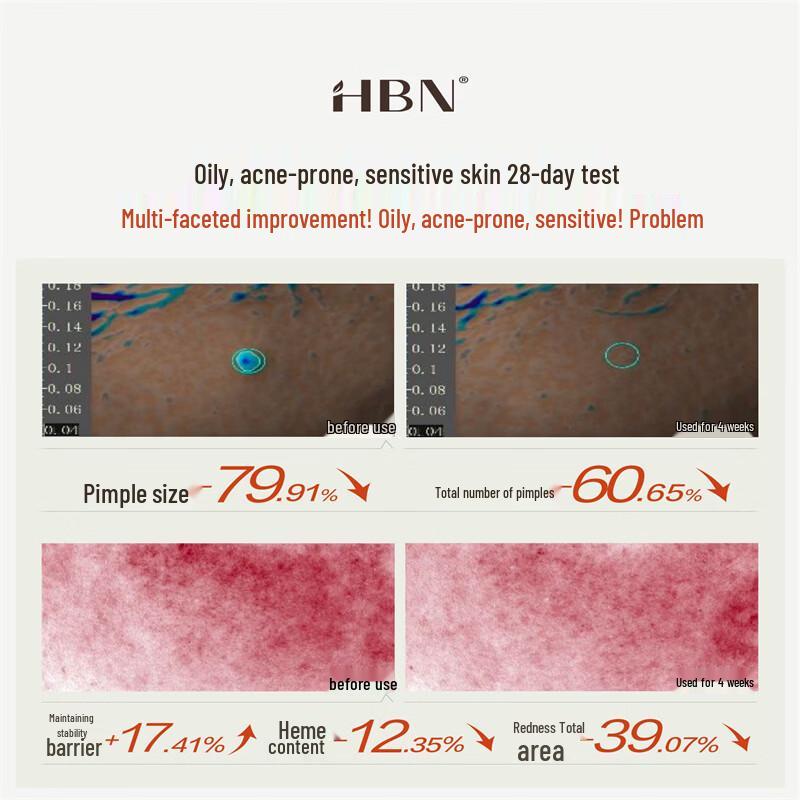 HBN Purifying Acne & Oil Control Lotion Set