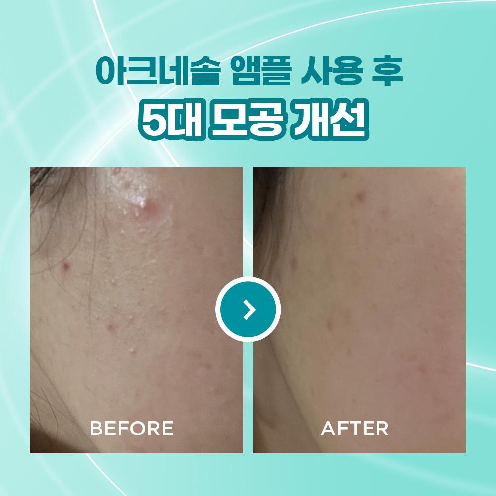    Atte [trouble Ampoule Sebum Care] Ate Acnesol Programming Ampoule Single Duo Planning Ampoule Single