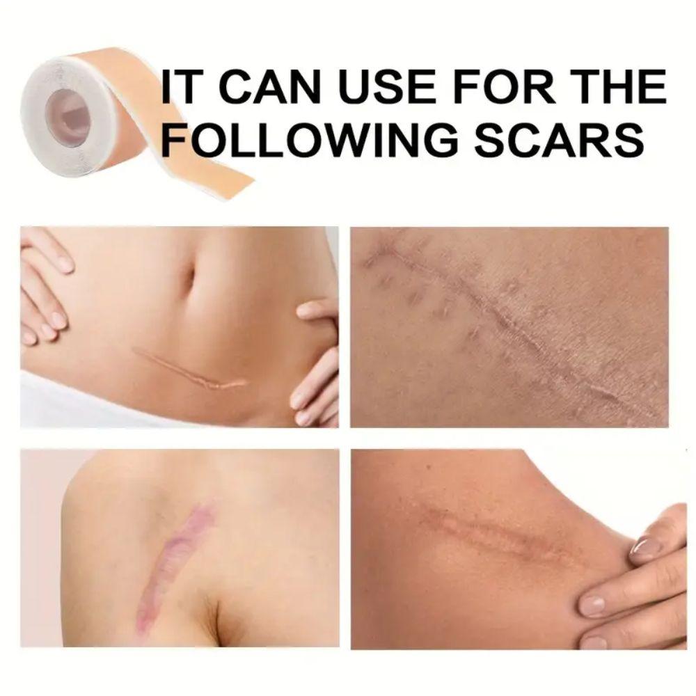 Self-Adhesive Scar Treatment Tape Easy-Tear Scar Care Patches Easy-to-Use Skin Cover Tape  Keloids