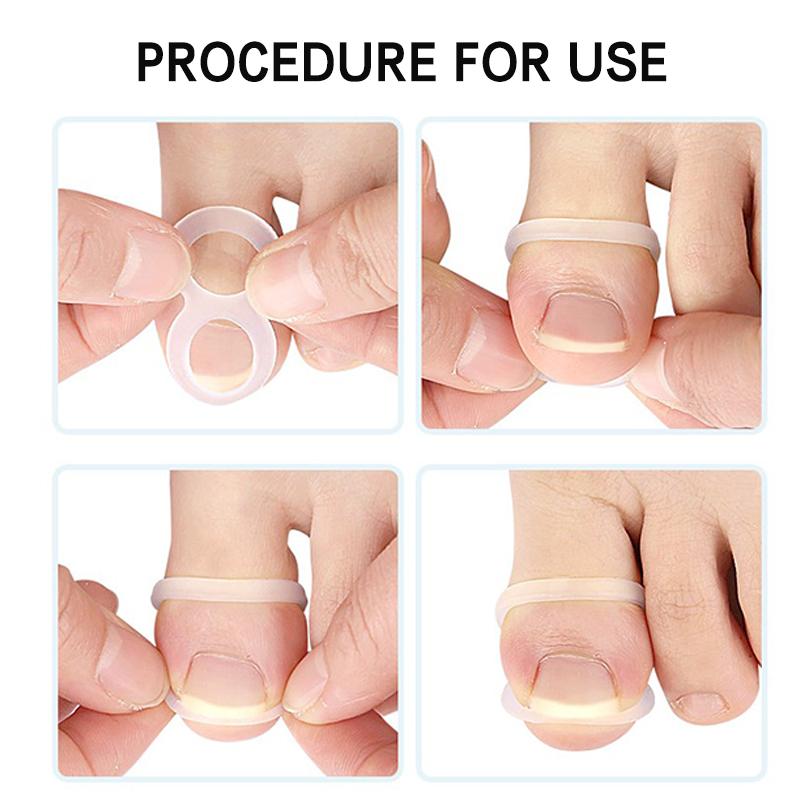 Herramienta de Silicona para Corrección de Uña Encarnada – Protector Enderezador Invisible y Soporte para Pedicura y Cuidado de los Pies