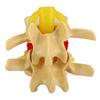 1:1.5 Lumbar Disc Herniation Demonstration Model Study Learn Human Spine