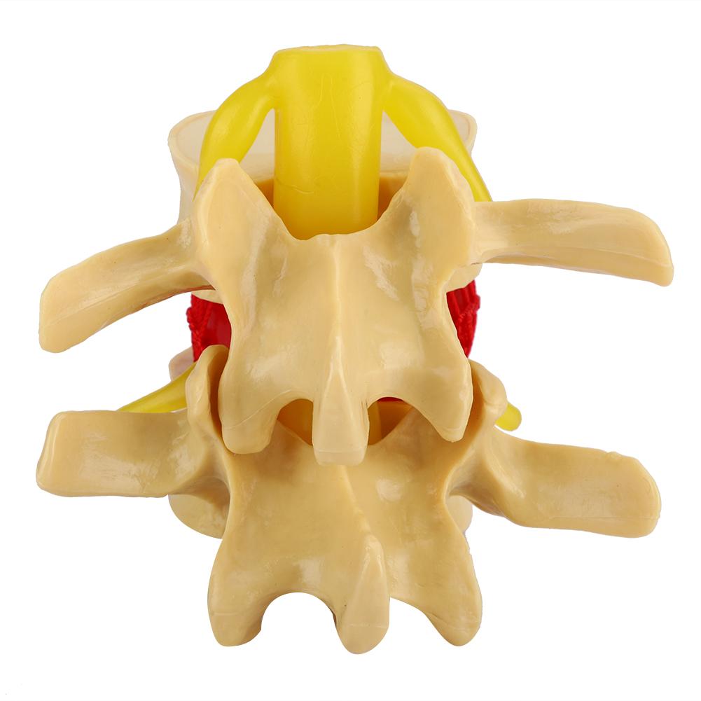 1:1.5 Lumbar Disc Herniation Demonstration Model Study Learn Human Spine