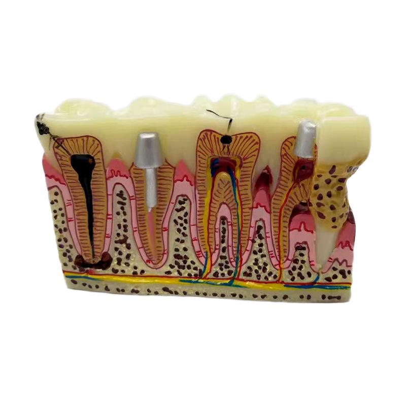Dental Oral Comprehensive Pathology Model: Caries Anatomy, Root Canal, Tooth Nerve Teaching Display 4029