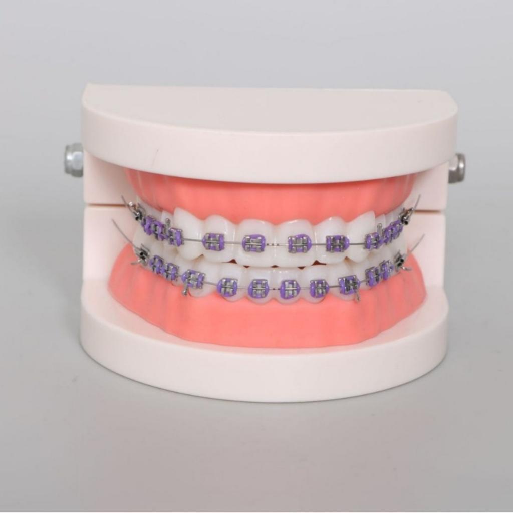 1 Stück Zahnärztliche Kieferorthopädische Behandlung Zähne Modell Mit Bracket Bogendraht Bukkalröhrchen Ligaturdrähte Zahnarzt Labor Zahnmodell Lehrmittel