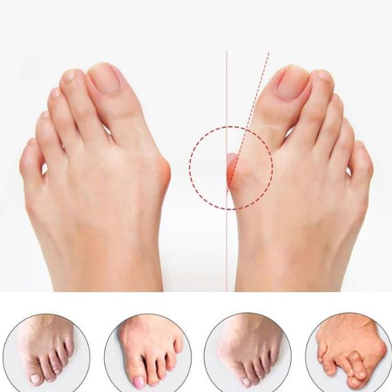 Zehentrenner-Korrektor SEBS Zehenpolster-Glätteisen Fußpflege-Tool Neu