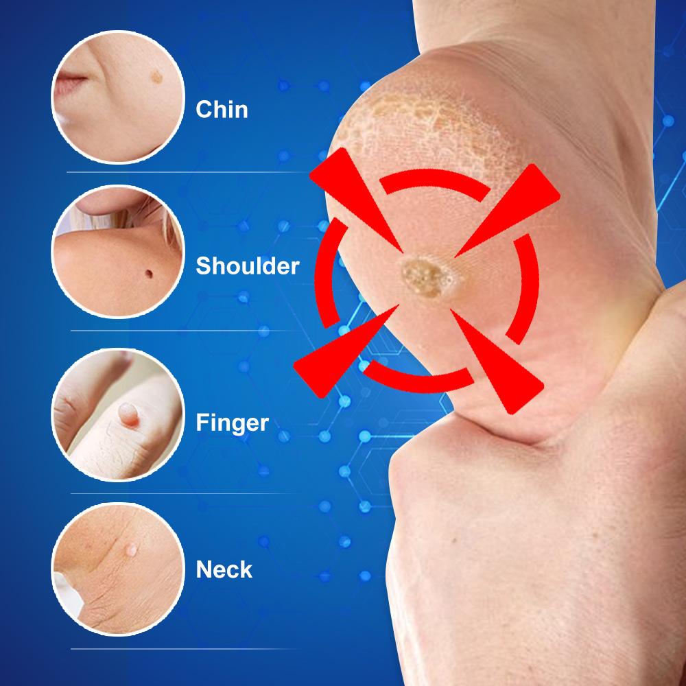 20G Foot Corn Removal Killer Foot Protection Pain Relief Curative Cream Medical Corns Plaster