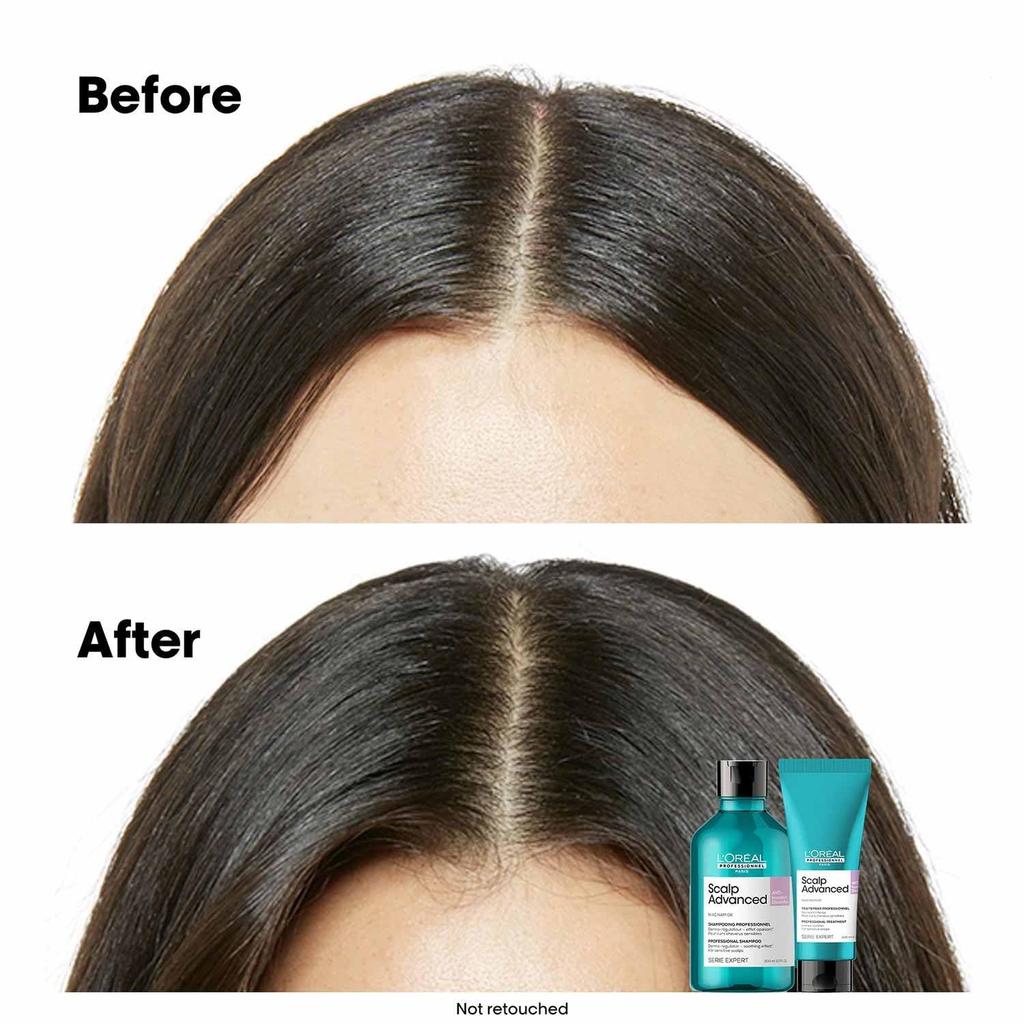 L'Oréal Professional Scalp Superior Treatment 200ml: Scalp care, for sensitive scalp, relieves discomfort, moisturizes, lightweight finish.