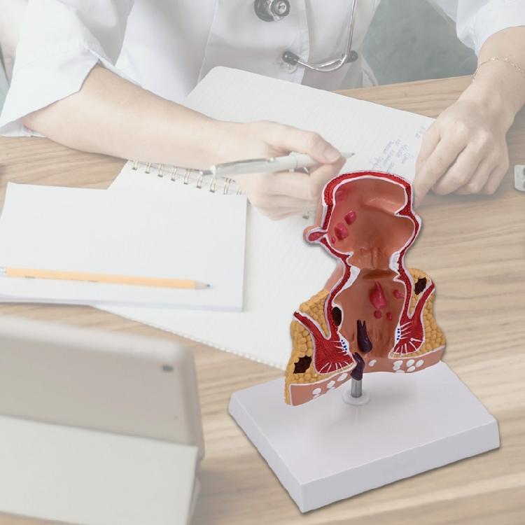 Human Pathologies of Rectum Model Human Rectum Model Human Anatomical Model Easy to Use Medicals Teaching Aid