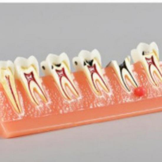 PH4011 Dental Caries Model: Teaching Tool for Tooth Decay and Evolution