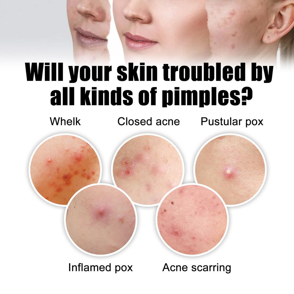 Large Capacity Pimple Patches, Colorful Cute Zit Covers,Hydrocolloid Acne Patches With Tea Oil, Witch Hazel, Centella Asiatica , Hyaluronic Sour