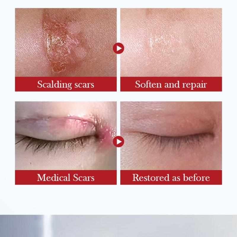 Scar Serum SADOER Hydrating Moisturizing Rejuvenating Moisturizing Cream
