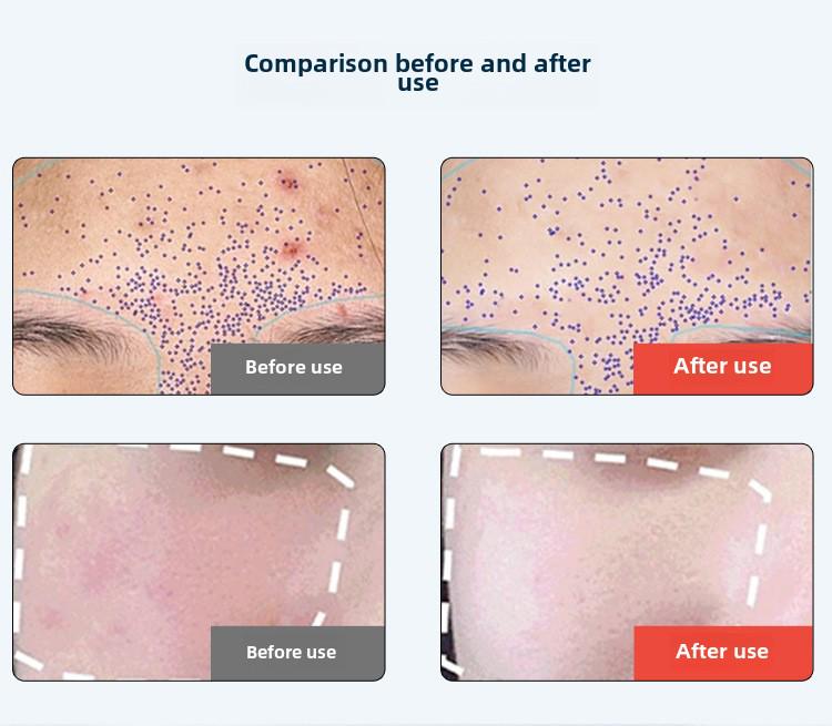 Cross-Border LED Infrared Photon Skin Rejuvenation Mask