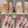 Réparation des ongles des mains et des pieds Onychomycète des ongles pour épaissir les ongles Suppresseur