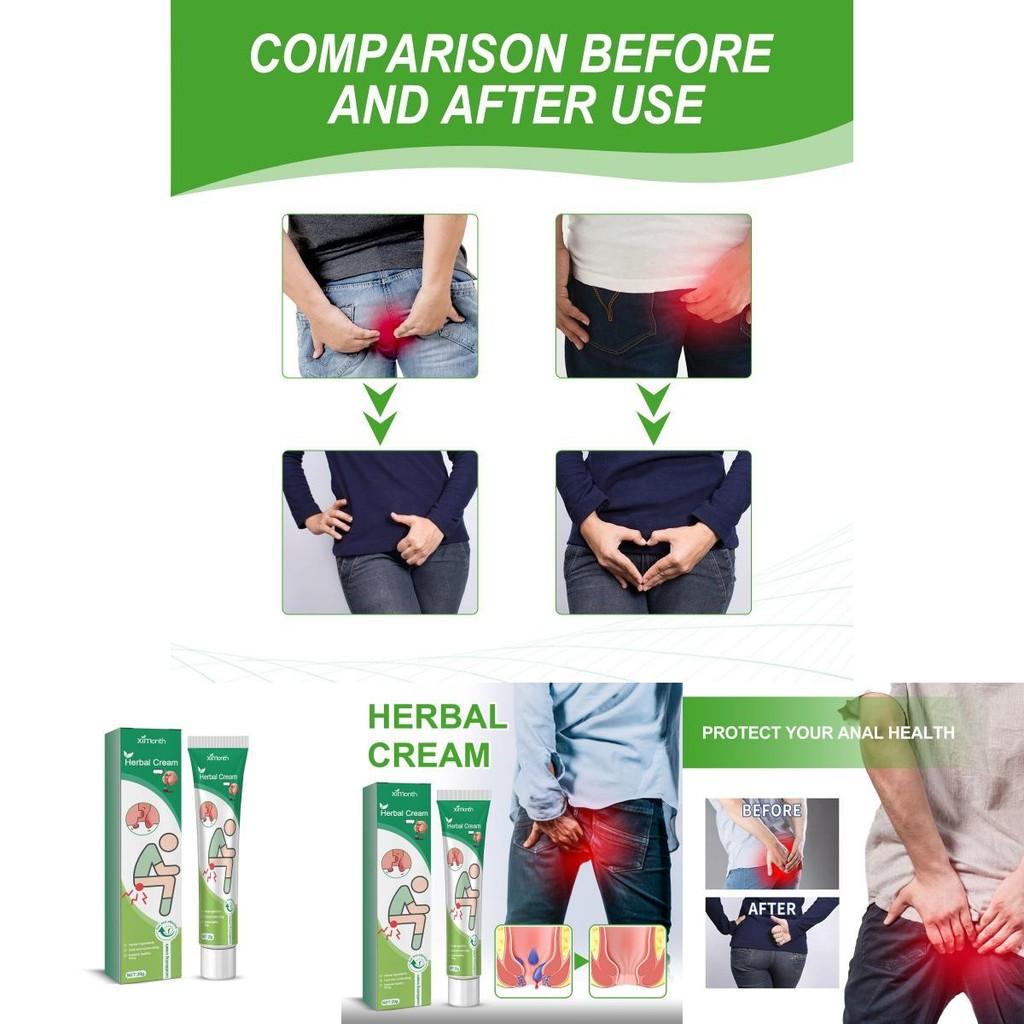 Ximonth Hemorrhoid Cream Soothing Relief For Anal Discomfort And Itching 20g