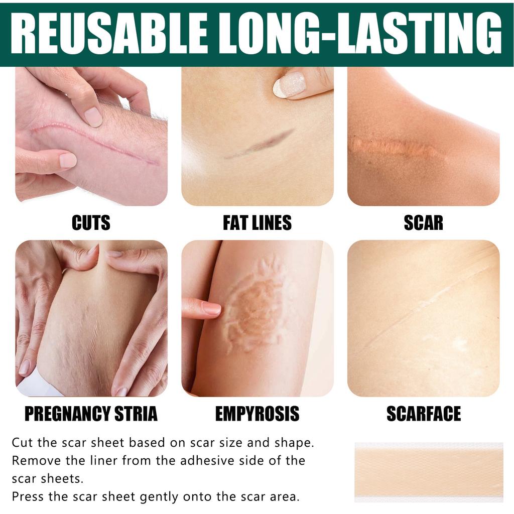 Scar Removal Gel Tape Self Adhesion Reusable Painless Scars Treatment Tapes for Hyperplastic Scars 59.1in