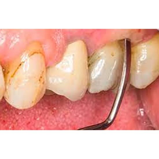 GDC Columbia Curettes 4r/4l Posterior Application #3 (Sc4r/4l)