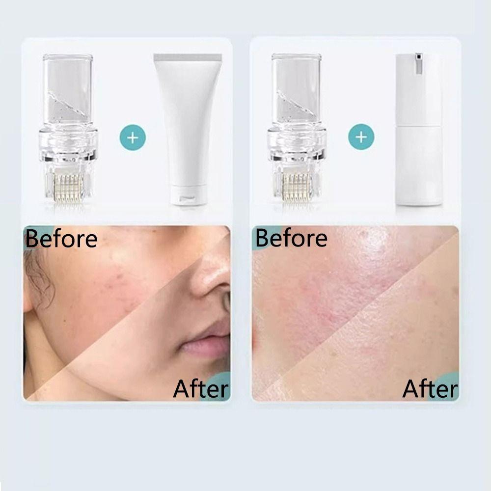 Reusable 64 Needle Hydra Roller Micro-Needle Hydra Needle Serum Applicator Home Use