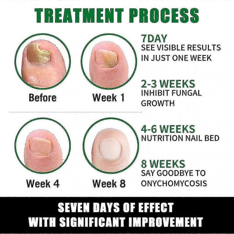 Jaysuing 7 Days Nail Fungus Treatment, Fast-Acting Nail Repair Serum with Ginger Formula, Promotes Healthy Nail Growth