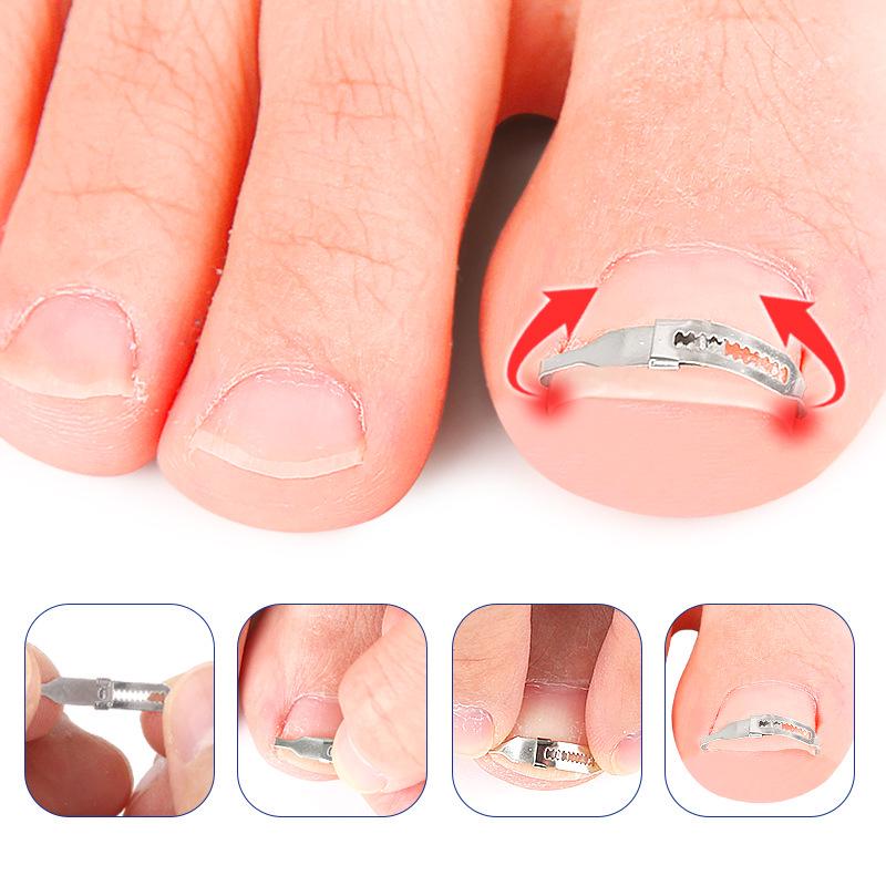 Ingrown Toenail Orthotic Patch & Foot Care Tool for Curled Nails and Nail Groove Ingrowth