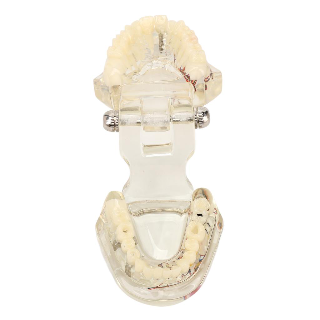Transparent Dental Implant Pathological Model Implant Disease Teeth Model for Teaching Demonstration