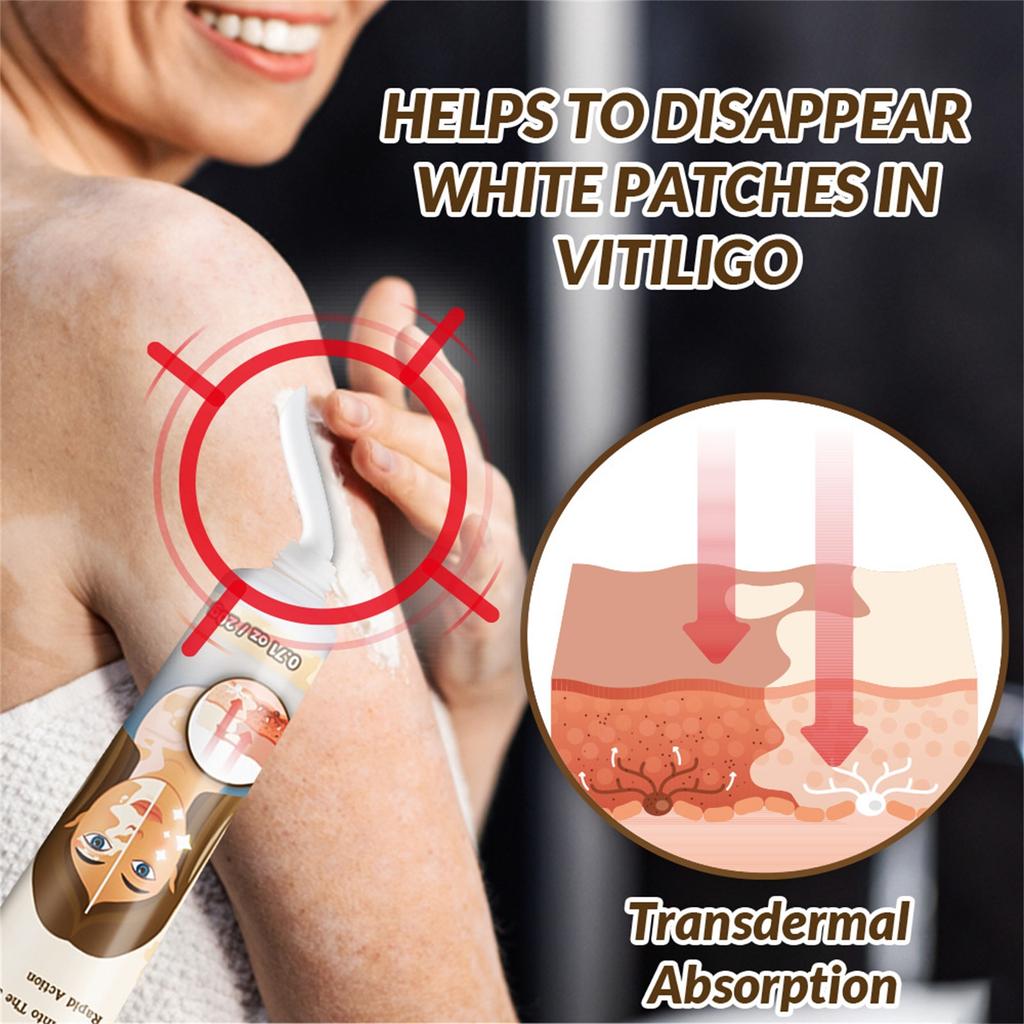 Vitiligo Cream, Natural Vitiligo Ease For Skin Vitiligo, Vitiligo Care Cream, Reduce Spots And Improve Skin Pigmentation, Easy To Use