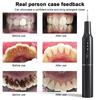 Ultrasonic Dental Cleaner with LED Light Home Use Teeth Cleaner Portable Dental Scaler Electric