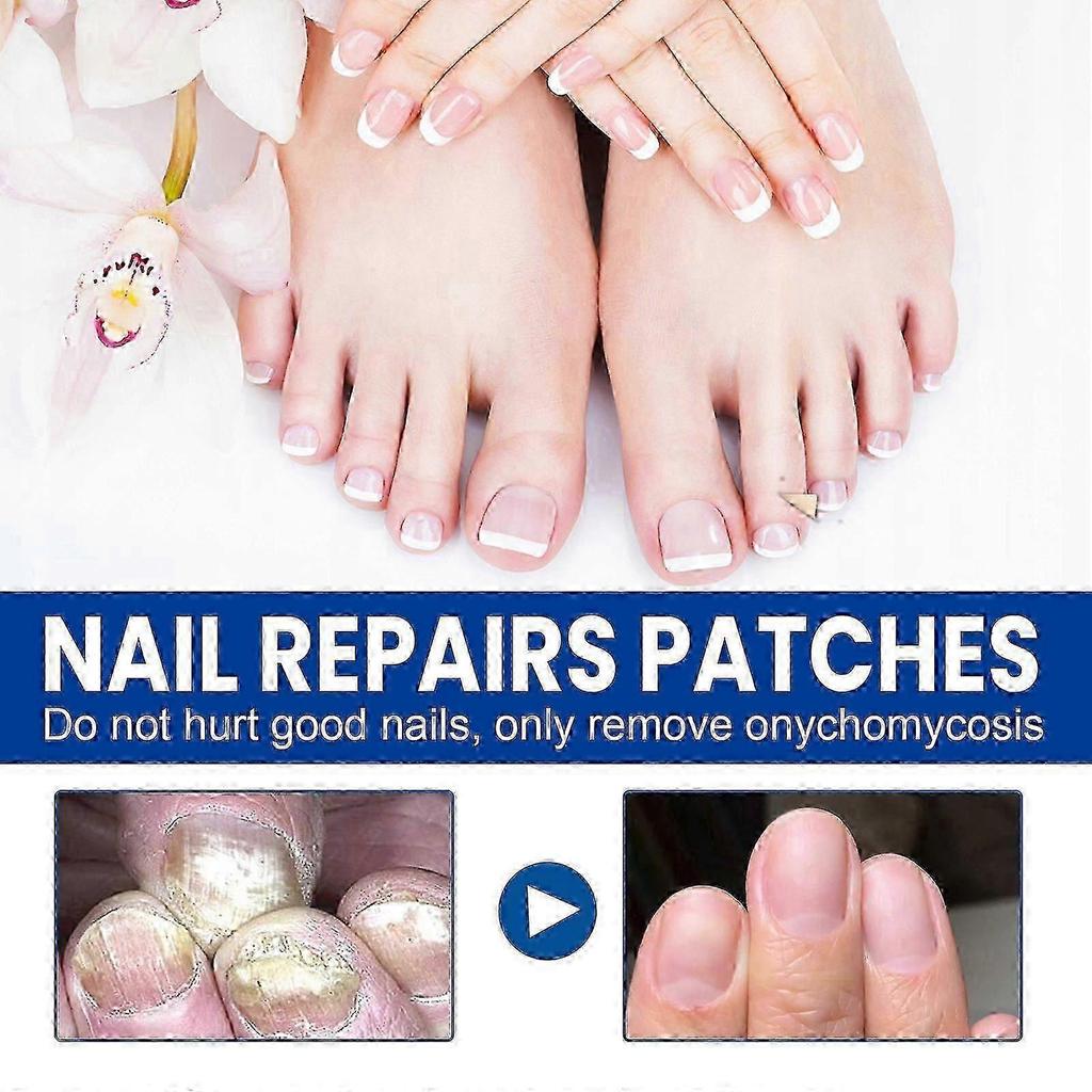Nail Repair Patch, Hands And Feet Soft Nail Inlaid Nail Thickening Bright Nail Furrow Gray Nail Care Patch