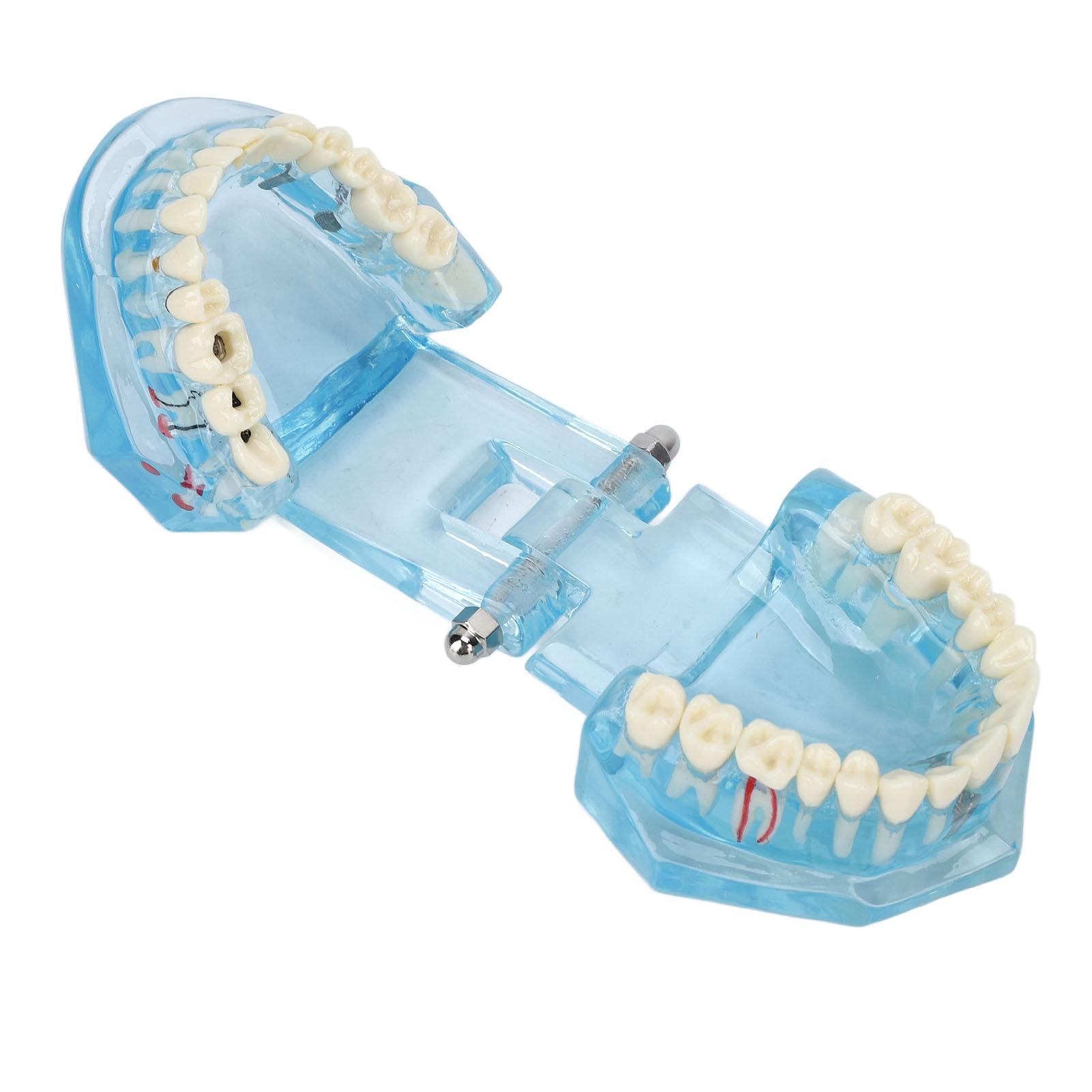 

Стоматологическая патологическая модель, прозрачная обучающая съемная модель для отображения зубов, синяя, прозрачная